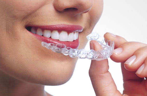 Alineadores Invisibles KeepSmiling: tu sonrisa, en evolución silenciosa